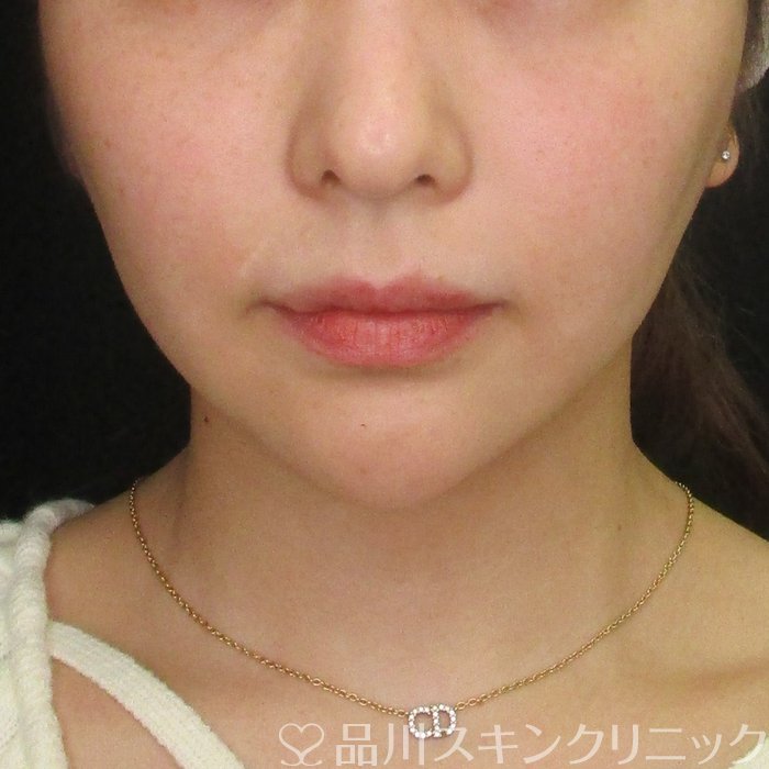 「美肌糸リフト」症例写真 Before