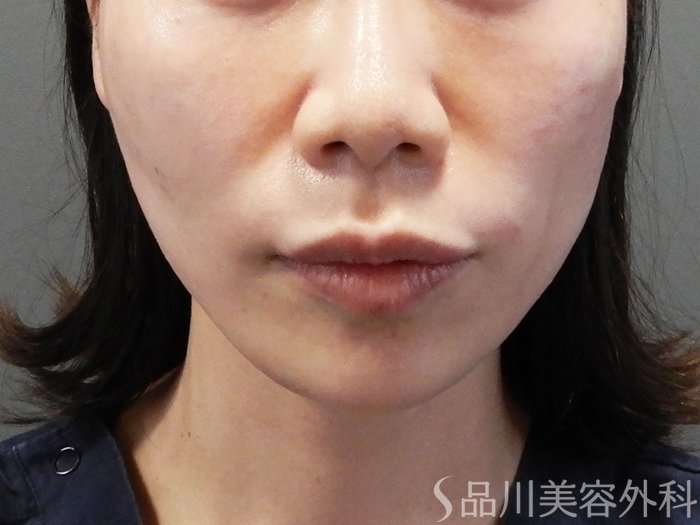 「美肌糸リフト」症例写真 After