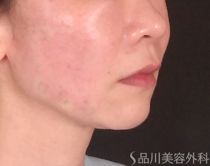「美肌糸リフト」症例写真 After