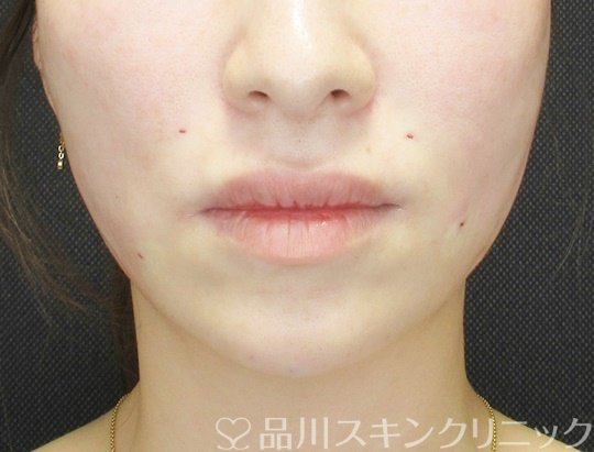 「美肌糸リフト」症例写真 After