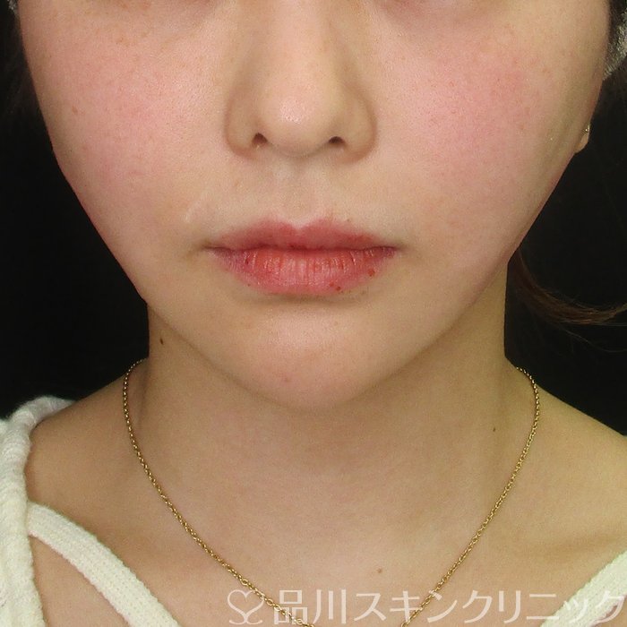 「美肌糸リフト」症例写真 After