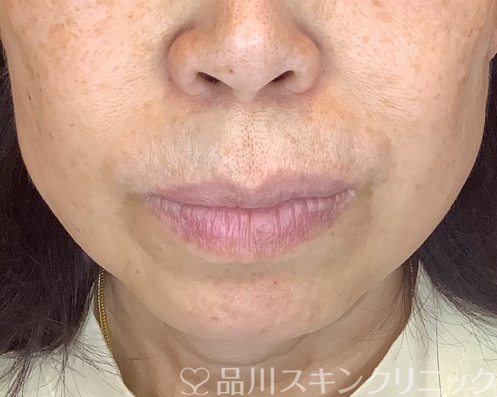 「美肌糸リフト」症例写真 After