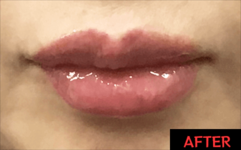 グロス注射® 症例写真3 After【画像】