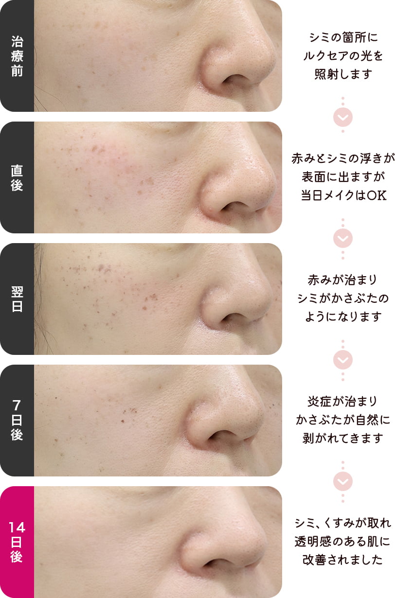 治療前：シミの箇所にルクセアの光を照射します 直後：赤みとシミの浮きが表面に出ますが当日メイクはOK 翌日：赤みが治まりシミがかさぶたのようになります 7日後：炎症が治まりかさぶたが自然に剥がれてきます 14日後：シミ、くすみが取れ透明感のある肌に改善されました