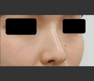 ヒアルロン酸によるプチ隆鼻術 症例写真1 After【画像】