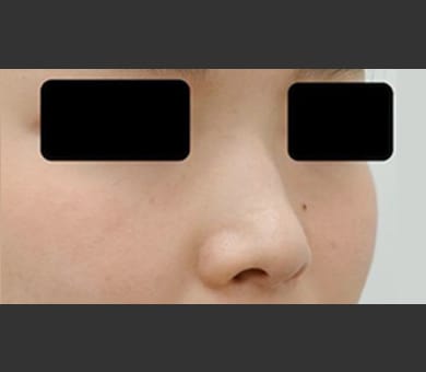 ヒアルロン酸によるプチ隆鼻術 症例写真1 Before【画像】