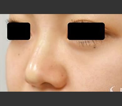 ヒアルロン酸によるプチ隆鼻術 症例写真2 After【画像】