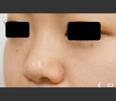 ヒアルロン酸によるプチ隆鼻術 症例写真2 Before【画像】