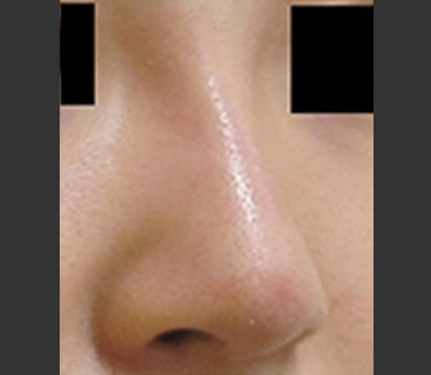 ヒアルロン酸によるプチ隆鼻術 症例写真3 After【画像】
