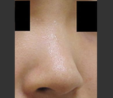 ヒアルロン酸によるプチ隆鼻術 症例写真3 Before【画像】