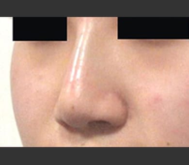 ヒアルロン酸によるプチ隆鼻術 症例写真4 After【画像】
