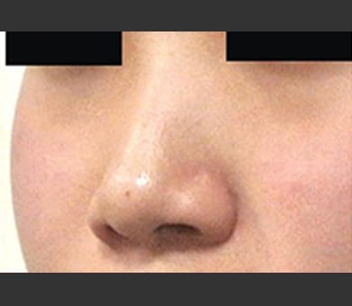ヒアルロン酸によるプチ隆鼻術 症例写真4 Before【画像】