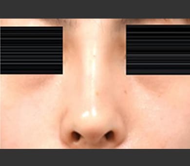 ヒアルロン酸によるプチ隆鼻術 症例写真5 After【画像】