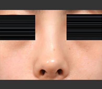 ヒアルロン酸によるプチ隆鼻術 症例写真5 Before【画像】