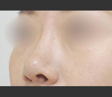 ヒアルロン酸によるプチ隆鼻術 症例写真6 After【画像】