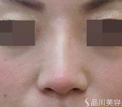ヒアルロン酸によるプチ隆鼻術 症例写真7 After【画像】