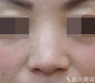 ヒアルロン酸によるプチ隆鼻術 症例写真7 Before【画像】