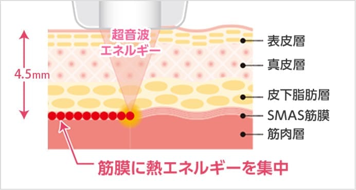 HIFU【画像】