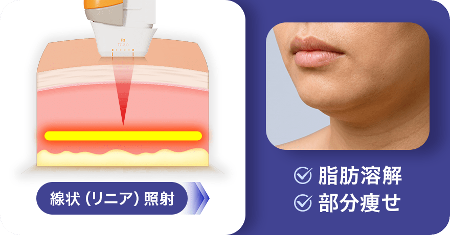 線状（リニア）照射 脂肪溶解・部分痩せ