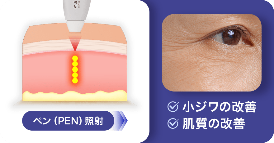 ペン（PEN）照射 小ジワの改善・肌質の改善