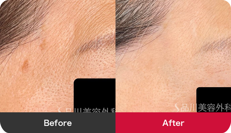 シミ取り治療の症例写真【画像】