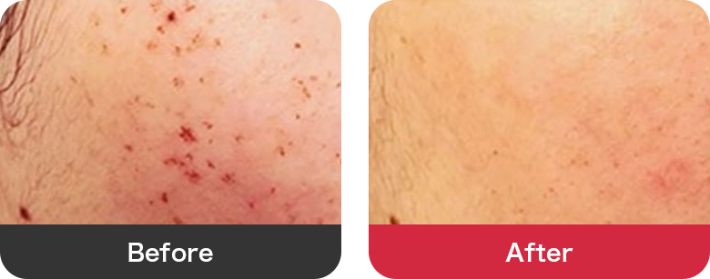 フォトシルクプラス 症例写真【画像】