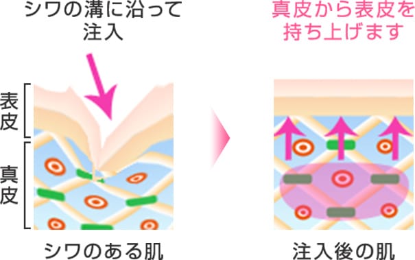 シワの溝にそってヒアルロン酸注入 真皮から表皮を持ち上げます【画像】