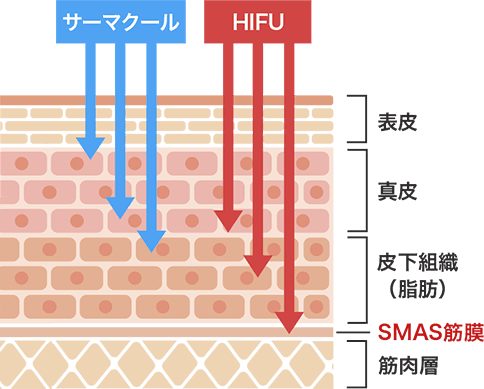 ハイフ（HIFU）と他の治療との違い