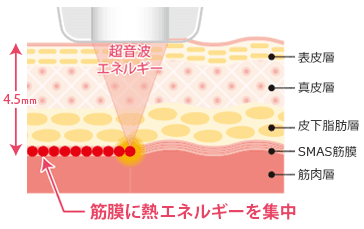 筋膜に熱エネルギーを集中