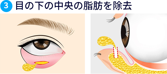 目の下の中央の脂肪を除去