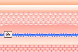 溶ける糸の挿入