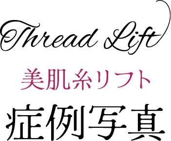 スレッドリフト 美肌糸リフト 症例