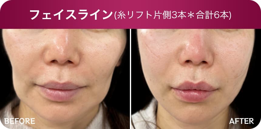 フェイスライン(糸リフト片側3本)*合計6本