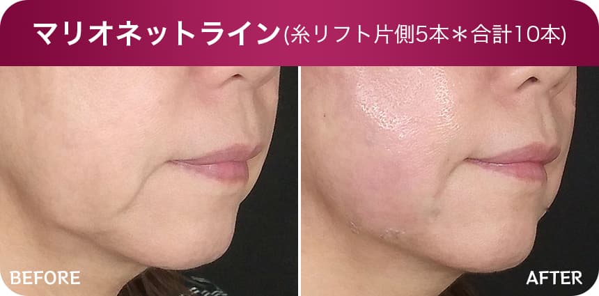 マリオネットライン(糸リフト片側5本)*合計10本