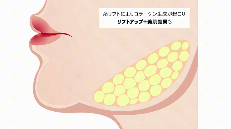 糸リフトのメカニズム