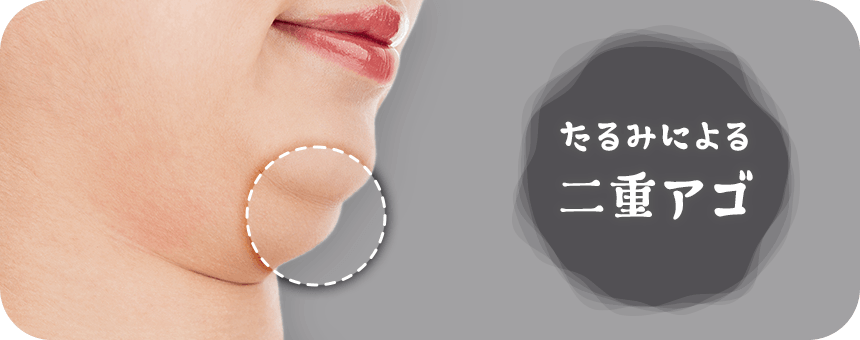 たるみが原因で二重になったアゴ