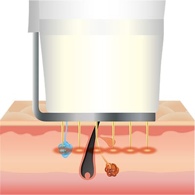 皮膚面から約1.0mm を治療開始位置とし、0.5mm おきに照射。【画像】