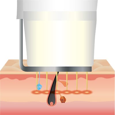 通常のRF（高周波エネルギー）では縦方向に広がる熱を、横方向に広げた新技術。【画像】