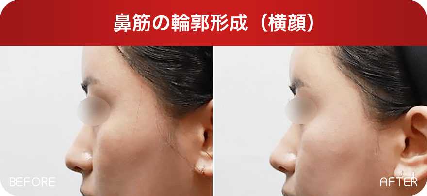 鼻筋の輪郭形成(横顔) Before & After