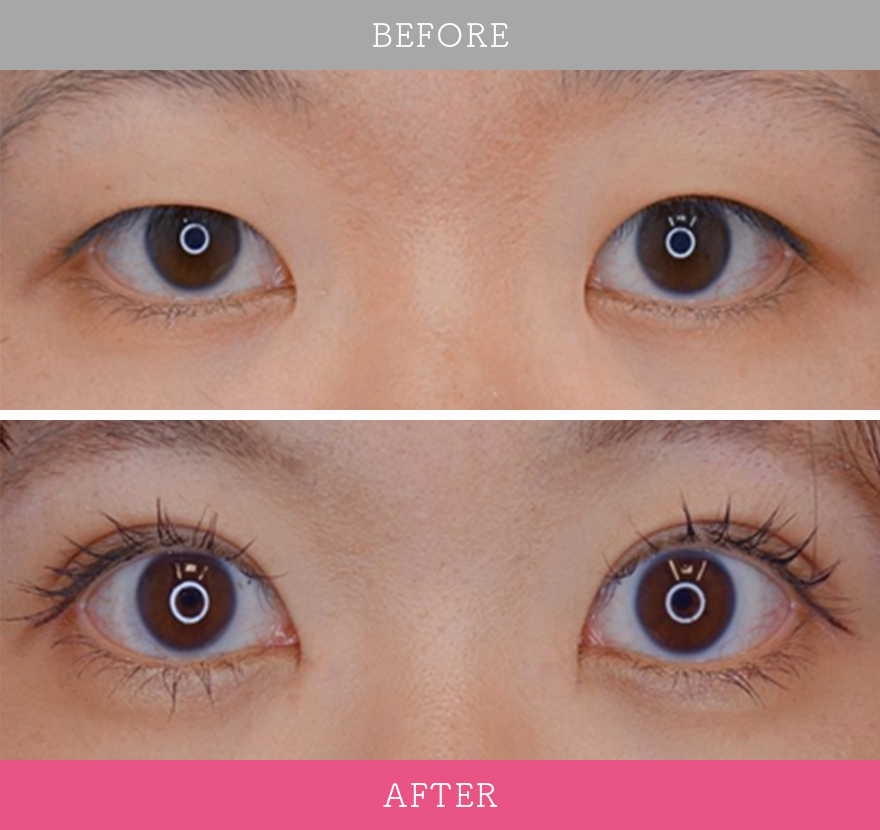 二重術エバーナチュラル法 症例写真