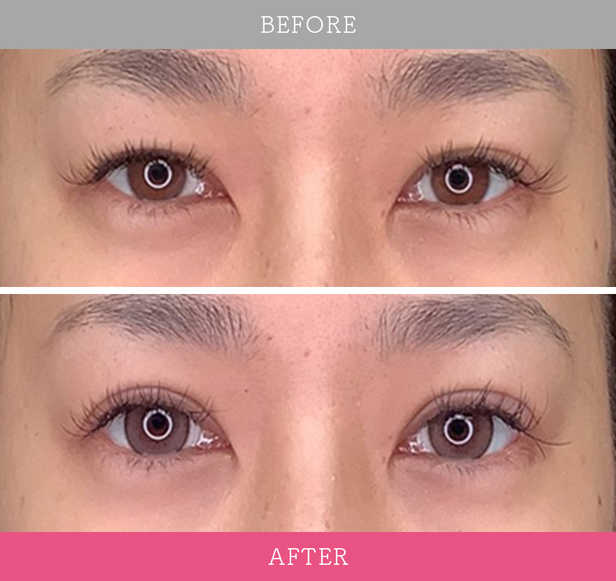 二重術エバーナチュラル法 症例写真