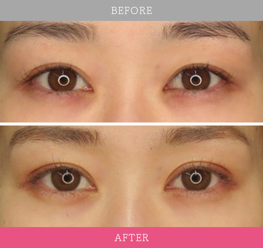 二重術エバーナチュラル法 症例写真