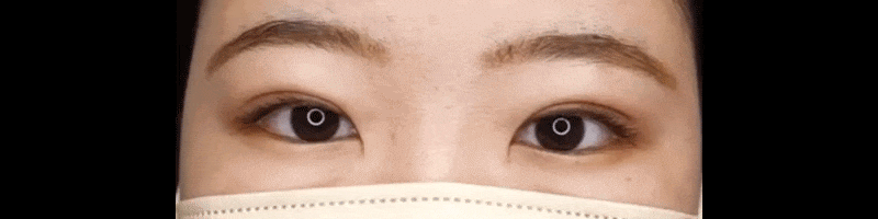 当院一番人気の埋没法！