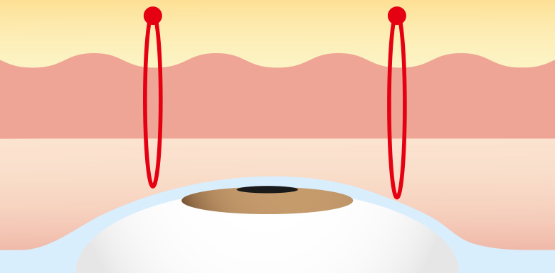 点留め方式（二重術クイック法）