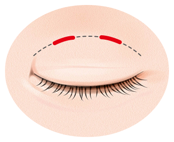 腫れるが引きが早い二重が取れにくい