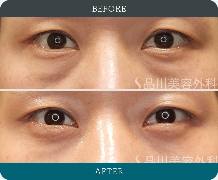 切らないクマ取り 症例写真