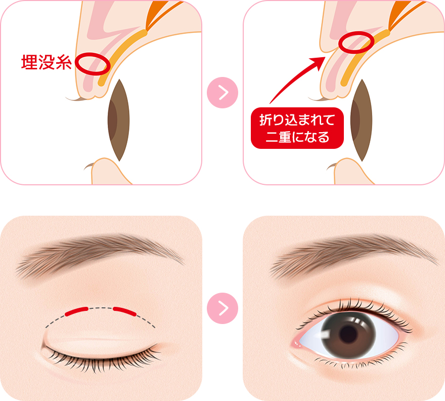 切らずにできる自然な二重 埋没法について