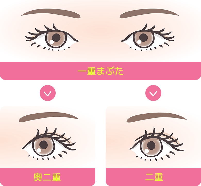 一重まぶた / 奥二重 / 二重