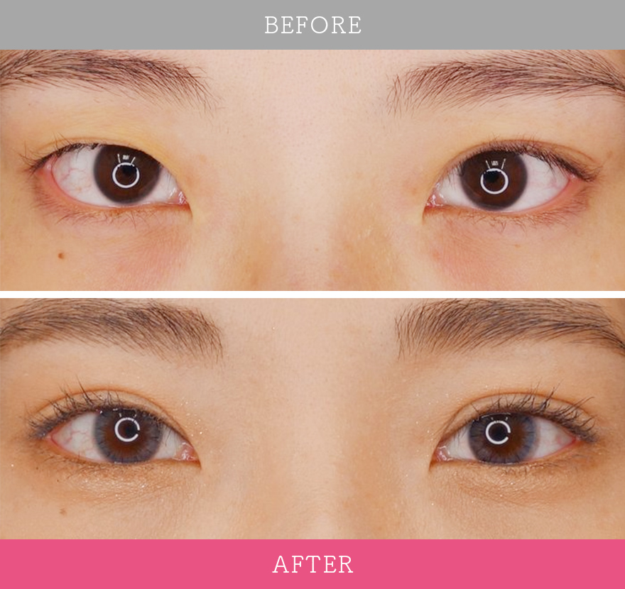 二重術ナチュラル法 症例写真