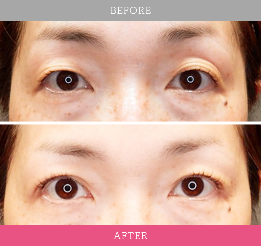 二重術ナチュラル法 症例写真